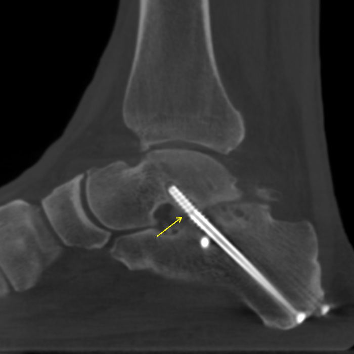 Case 1 Lateral XRay